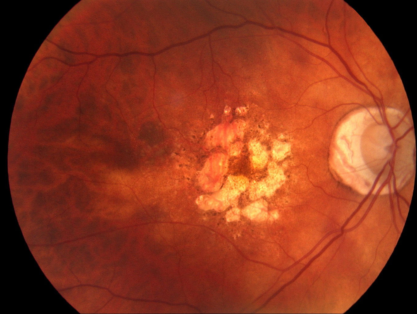 Julie Heraghty 4BC   Macula With Macular Degeneration 