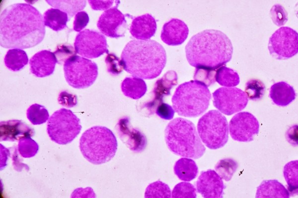 Blood cancer, underestimated and under reported - 4BC